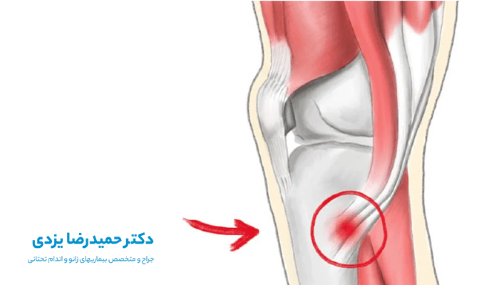 Pes anserine burcitis