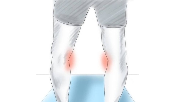 انحراف زانو