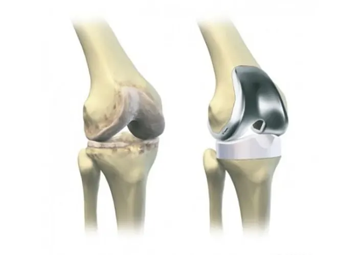 برترین پزشک تعویض مفصل زانو