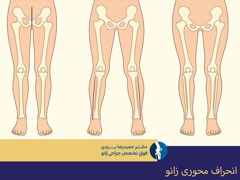 انحراف محوری زانو