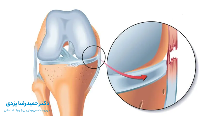 تفاوت بین پارگی کامل و جزئی رباط زانو