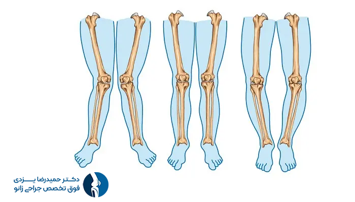 تغییر شکل زانو