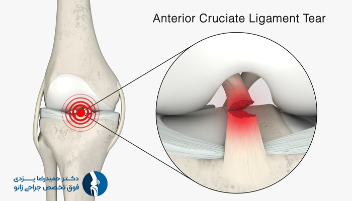 رباط صلیبی قدامی ACL