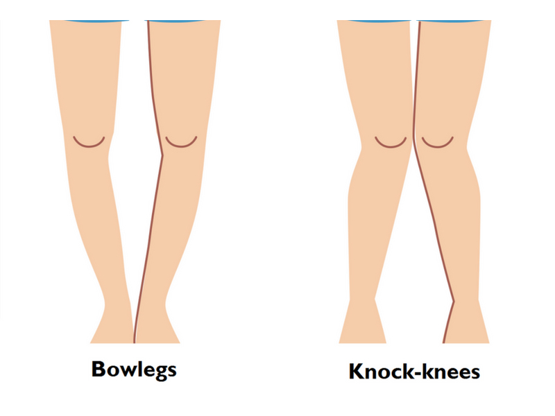علت تغییر شکل زانو