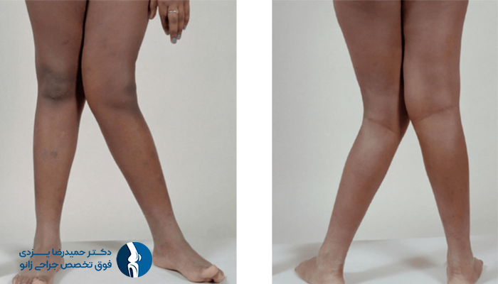 علل اصلی تغییر شکل زانو