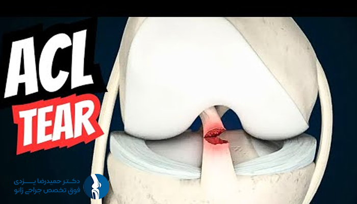 مراحل جراحی رباط صلیبی قدامی