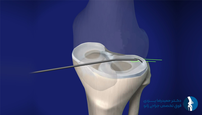 نکات کلیدی در نقاهت مینیسک زانو