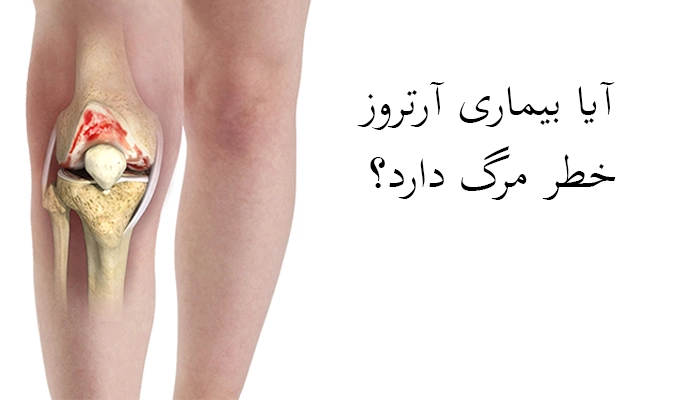 آیا بیماری آرتروز خطر مرگ دارد؟