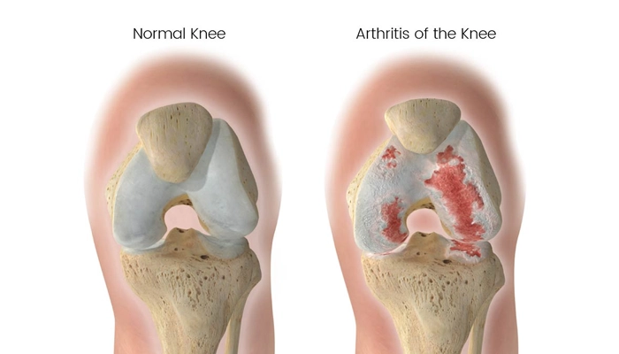 زانو سالم و زانوی داراری بیماری آرتروز