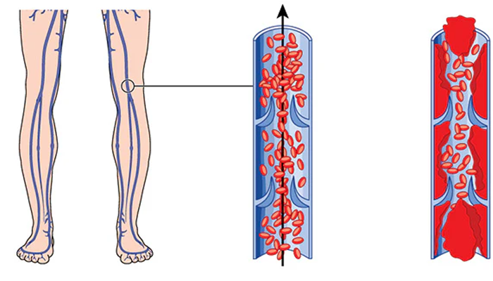لخته شدن خون بعد از تعویض مفصل زانو