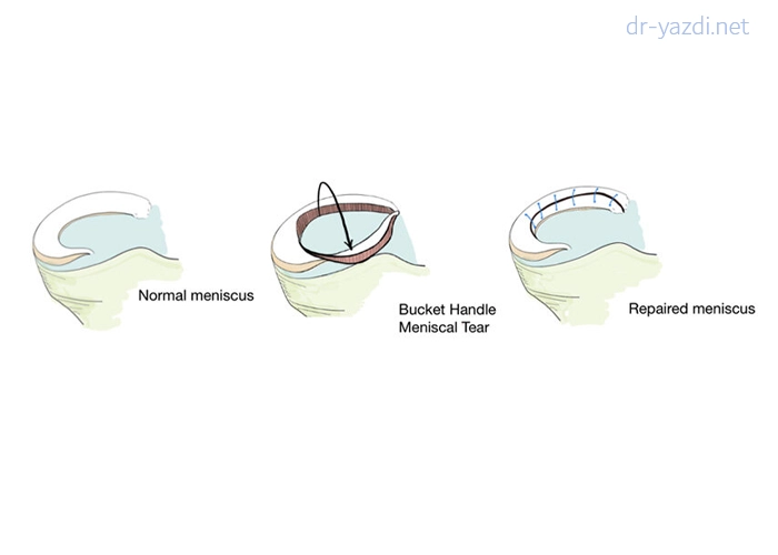 درمان پارگی دسته سطلی مینیسک