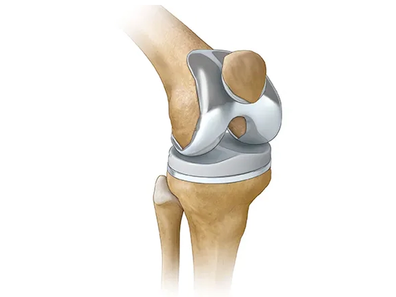 رضایت بیماران از عمل تعویض مفصل زانو
