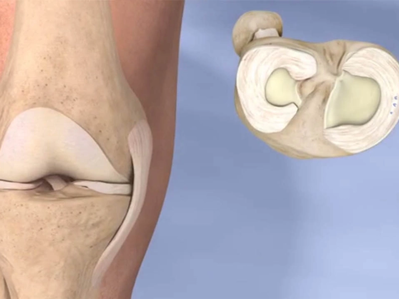 پارگی درجه ۲ مینیسک زانو