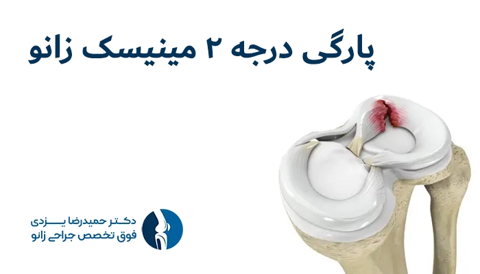 پارگی درجه ۲ مینیسک
