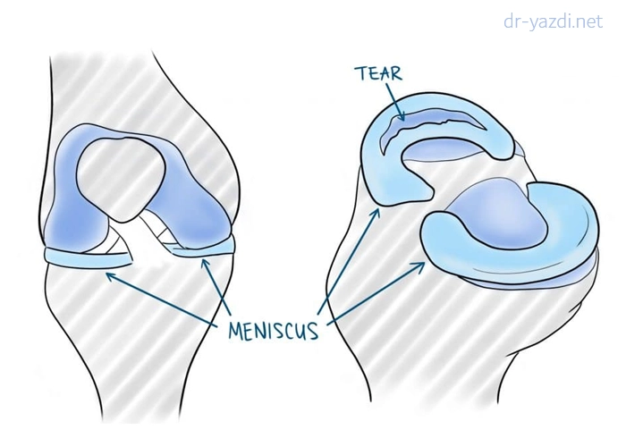 پارگی دسته سطلی مینیسک