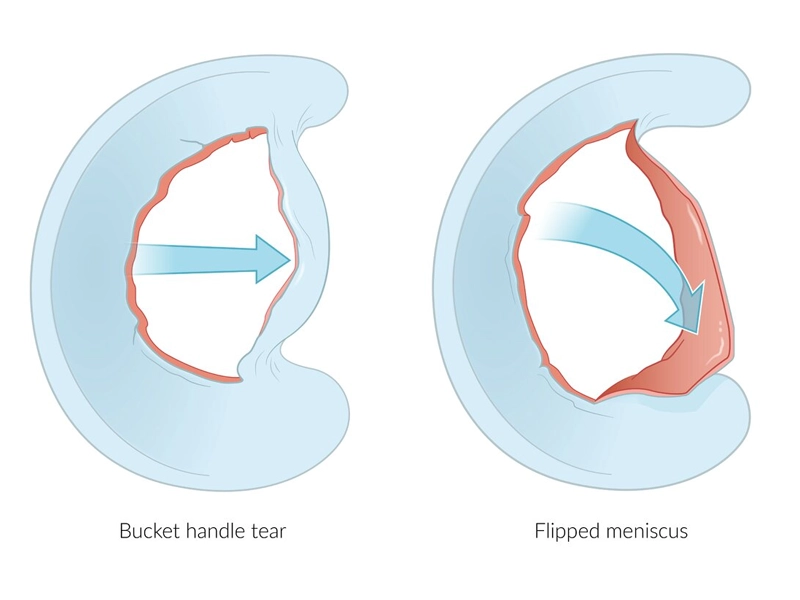 پارگی دسته سطلی مینیسک