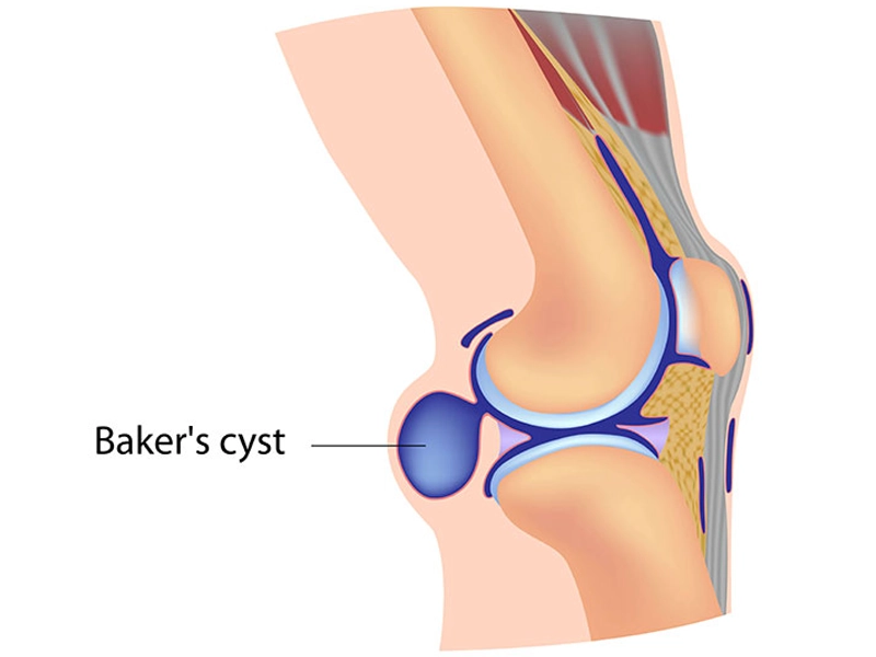 Baker's cyst