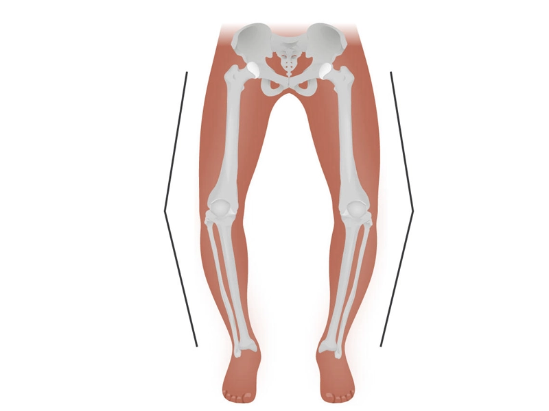زانوی پرانتزی در بزرگسالان