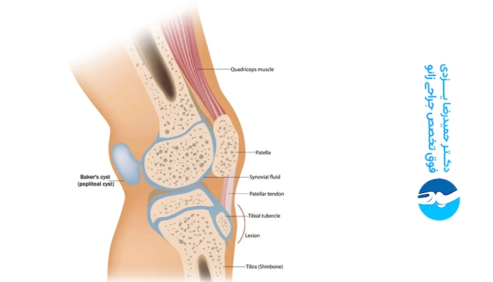 علائم کیست زانو