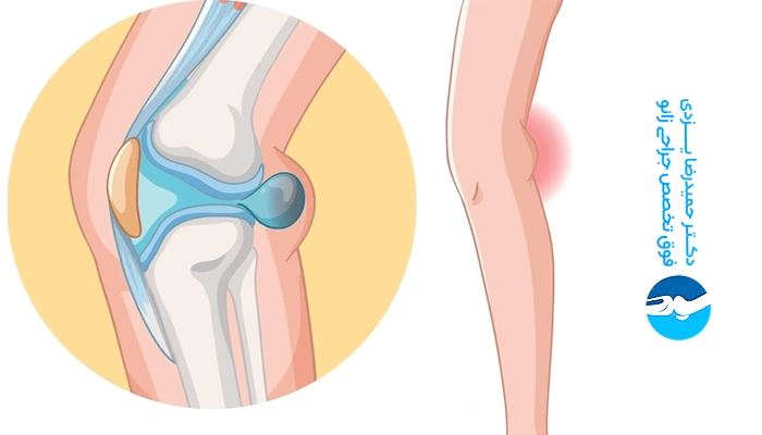 علت ایجاد کیست زانو