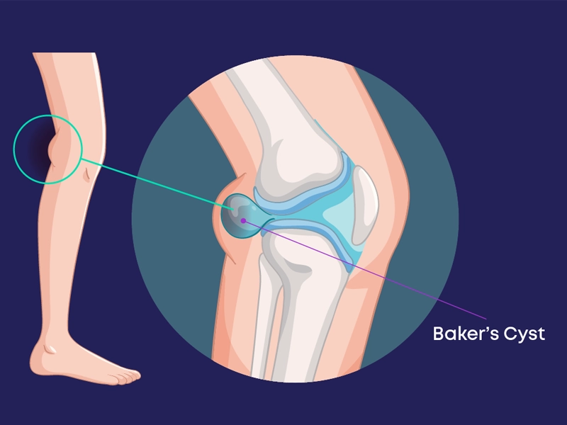 انواع کیست زانو