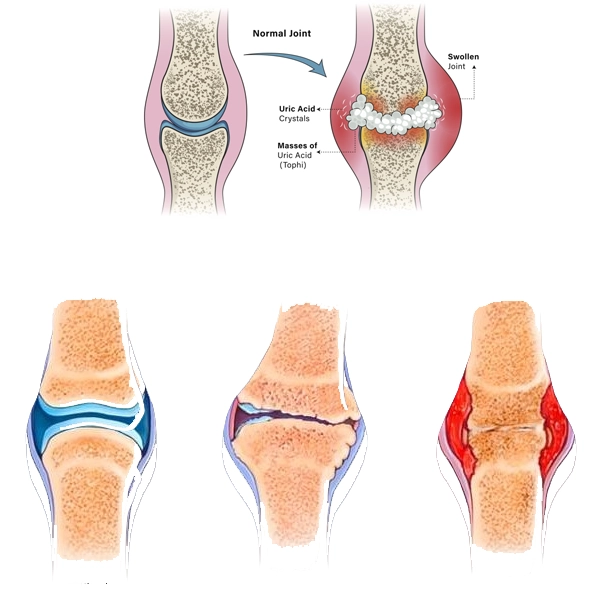 تفاوت بین روماتیسم مفصلی زانو و نقرس زانو