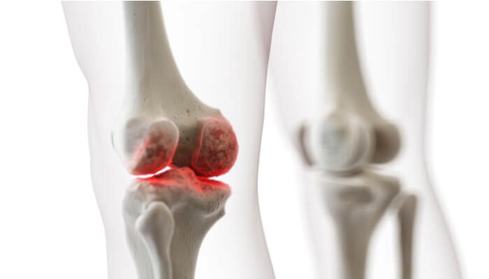 درمان عفونت زانو