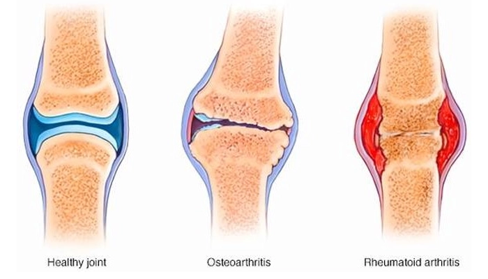 روماتیسم زانو