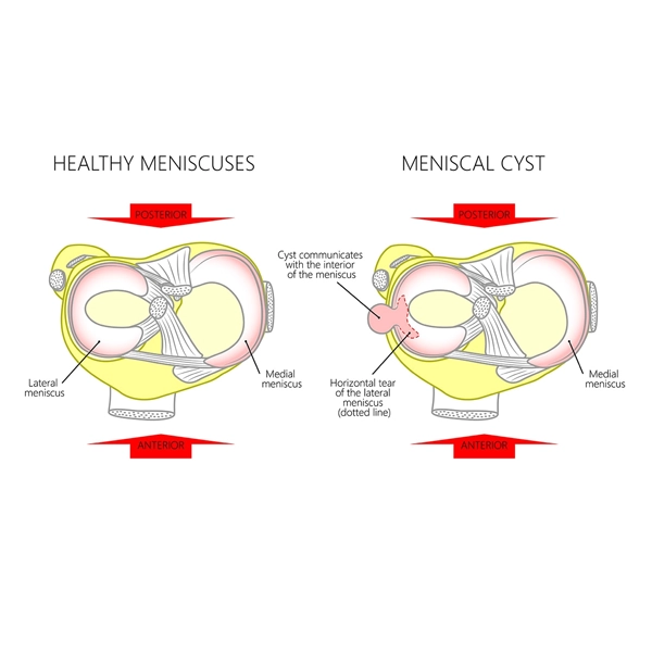 کیست پارامنیسکال