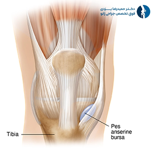 Pes Anserine Bursitis