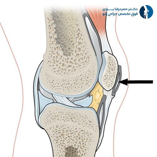 Prepatellar Bursitis