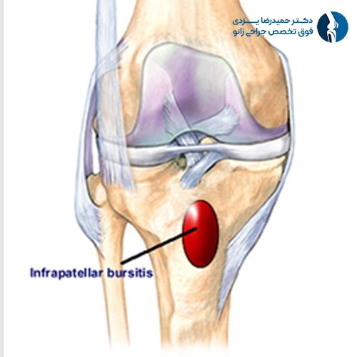 nfrapatellar Bursitis