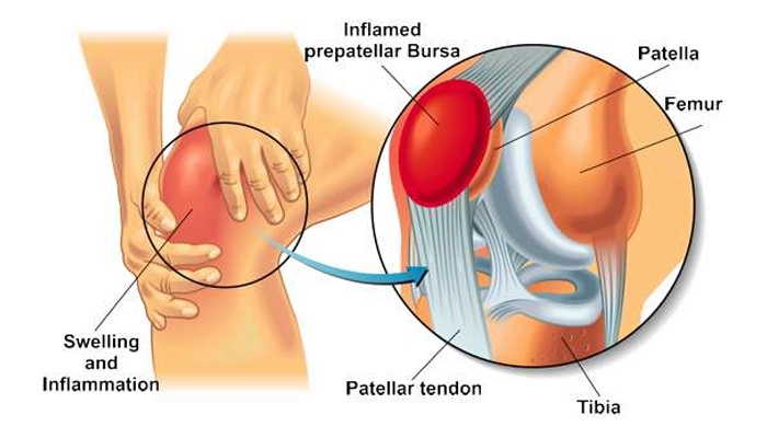 بورسیت زانو