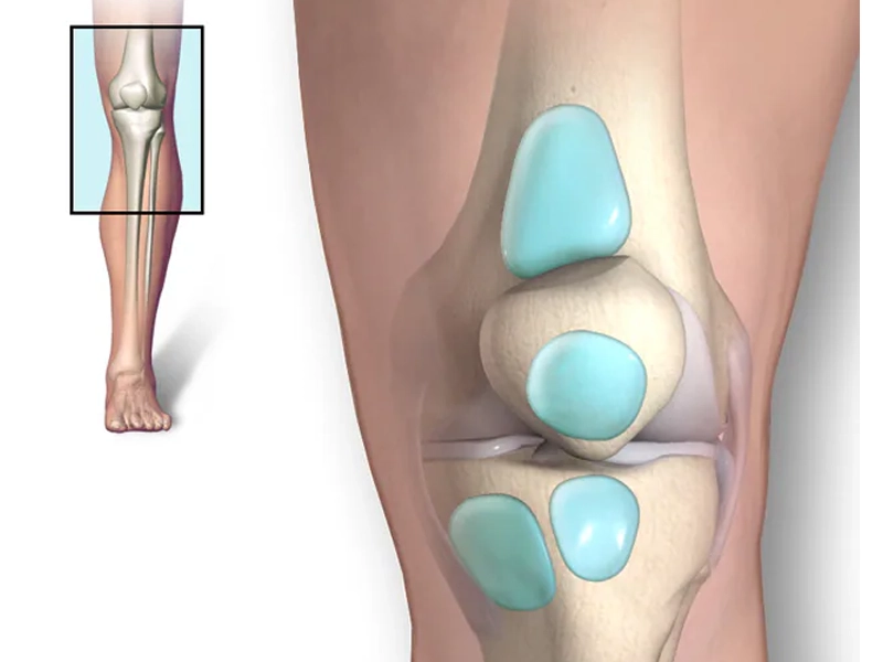 سندرم‌های بورسیت زانو