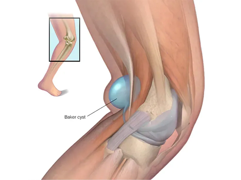کیست بیکر زانو