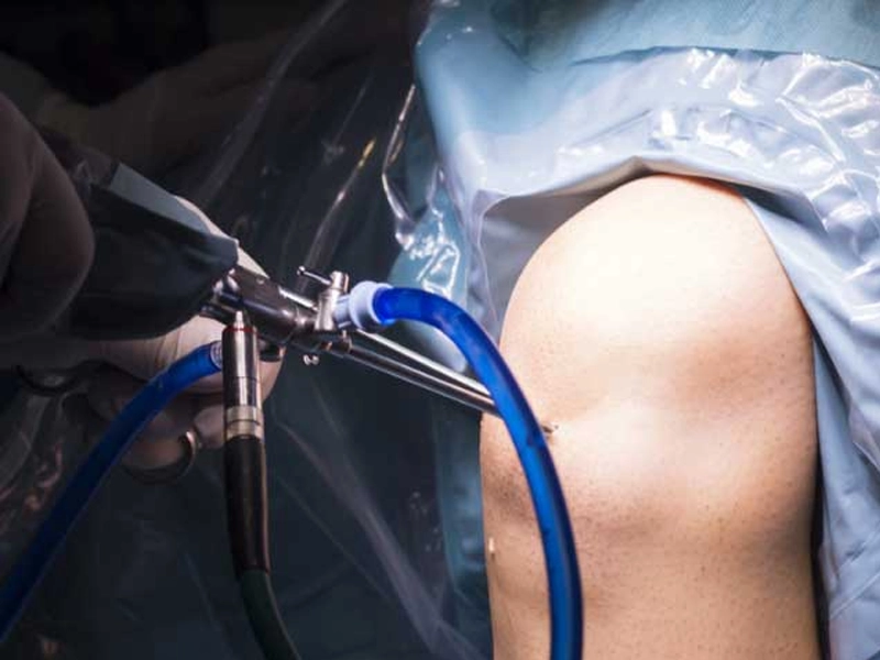 درصد موفقیت آرتروسکوپی زانو