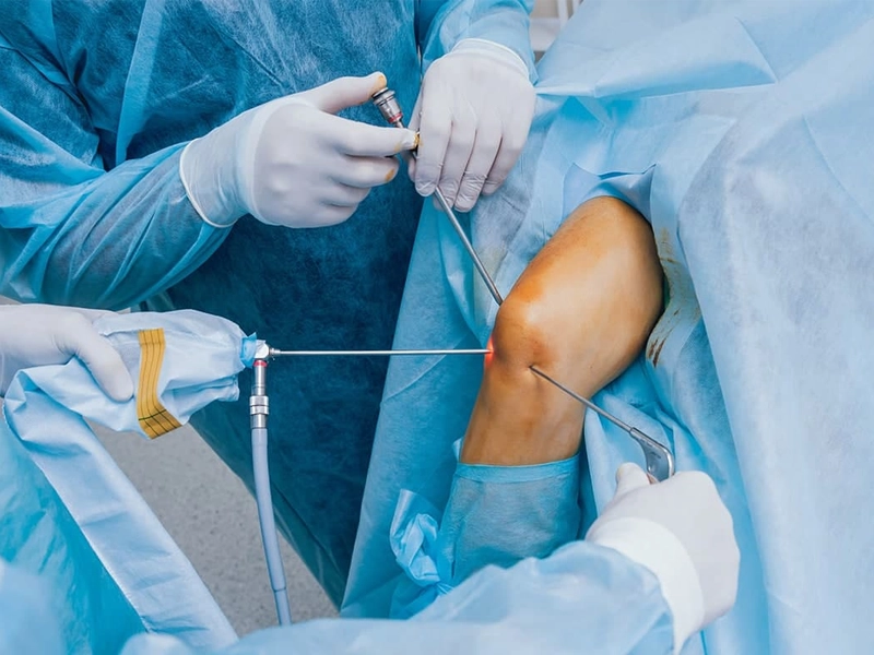 مدت زمان بهبودی بعد از آرتروسکوپی زانو