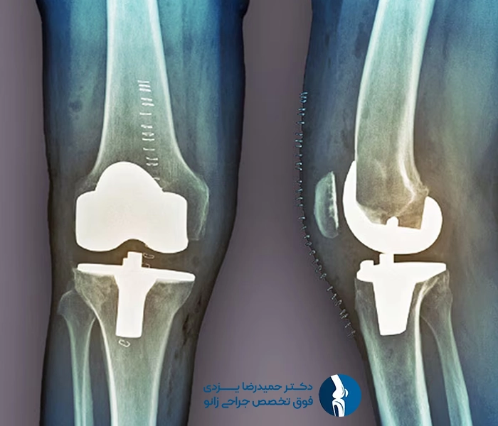 پروتز برای مفصل زانو