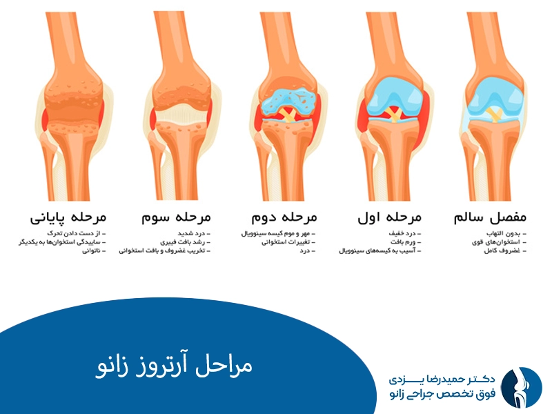 مراحل آرتروز زانو