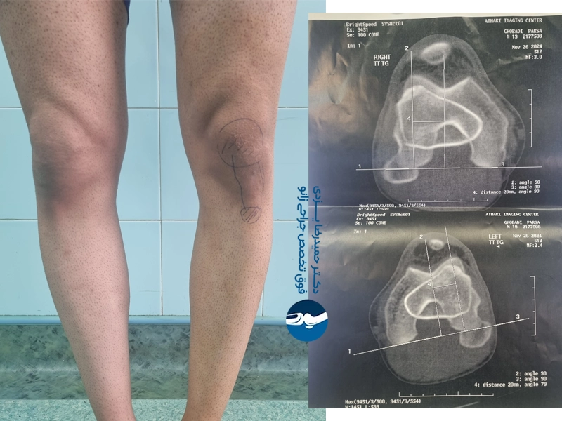 پای پرانتزی