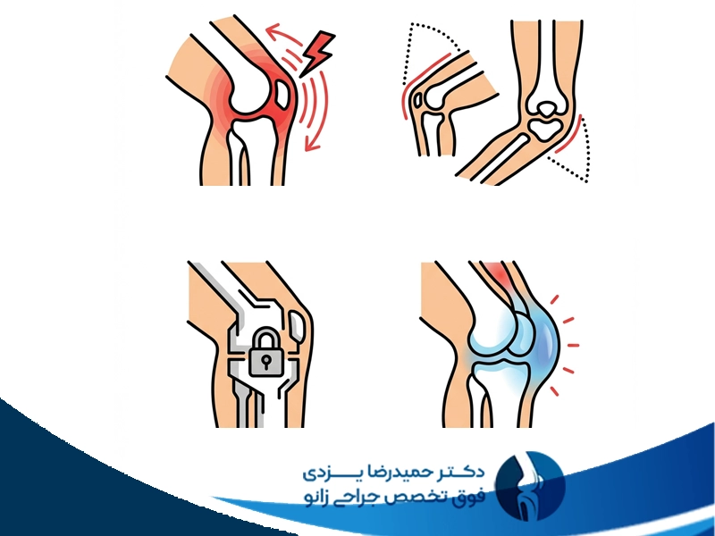 علائم خشکی زانو بعد از تعویض مفصل