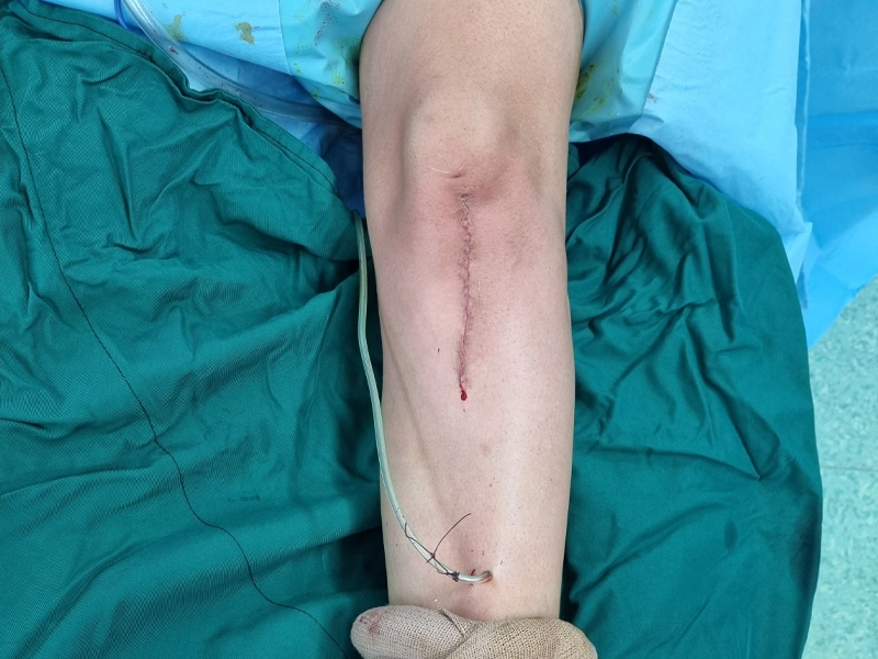 عمل زانو پرانتزی