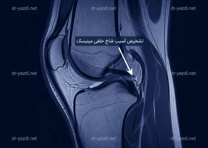 تشخیص آسیب شاخ خلفی مینیسک